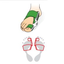 Bütyökkezelő (Hallux Valgus)